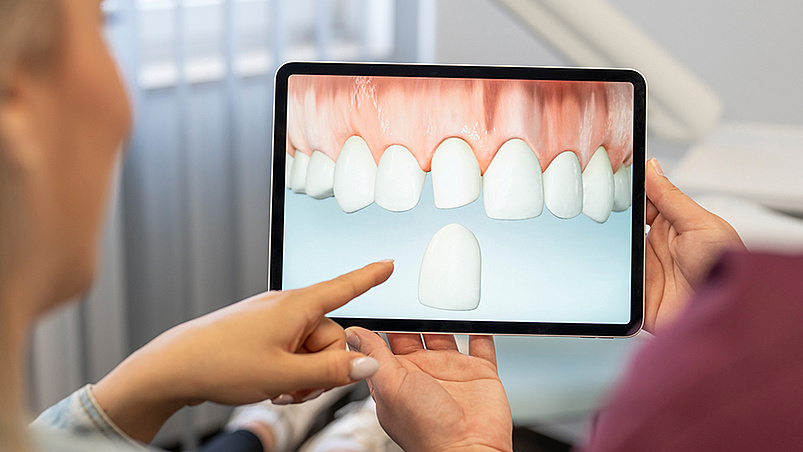 Veneers (Verblendschalen)